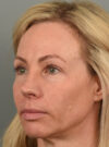 Eyelid Surgery case #11801