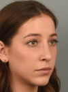 Chin Augmentation case #11702