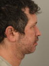 Chin Augmentation case #11311