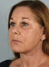 Eyelid Surgery case #11400