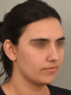 Buccal Fat Reduction case #11294