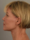 Facelift case #11486