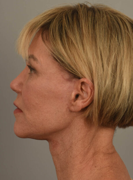 Facelift case #11486