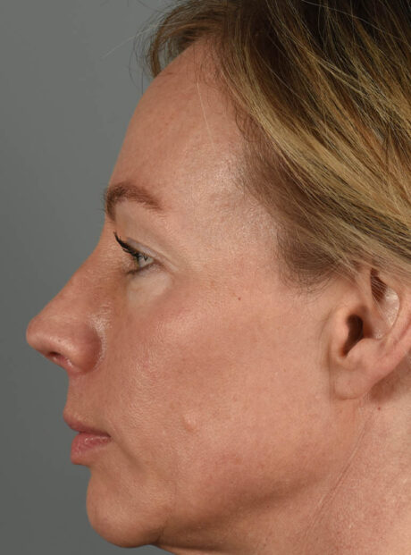 Eyelid Surgery case #11801