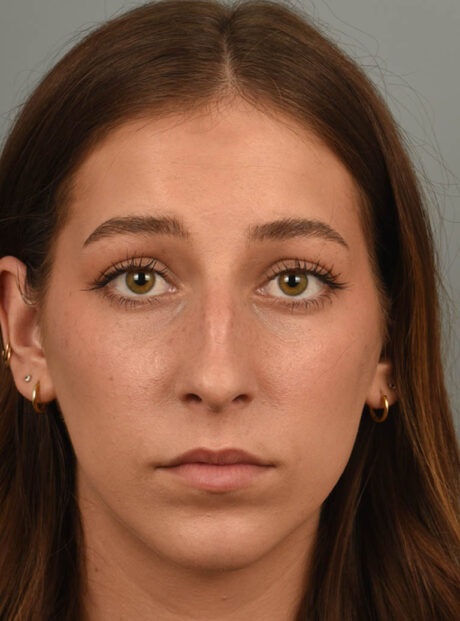Chin Augmentation case #11702