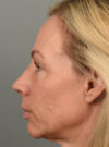 Eyelid Surgery case #11801