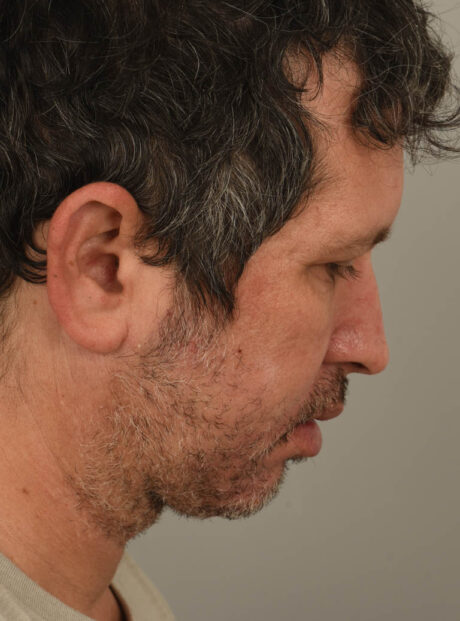 Chin Augmentation case #11311
