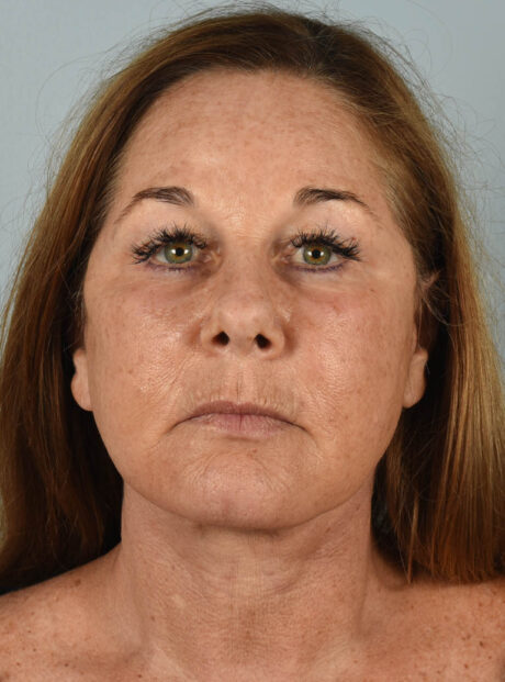 Eyelid Surgery case #11400