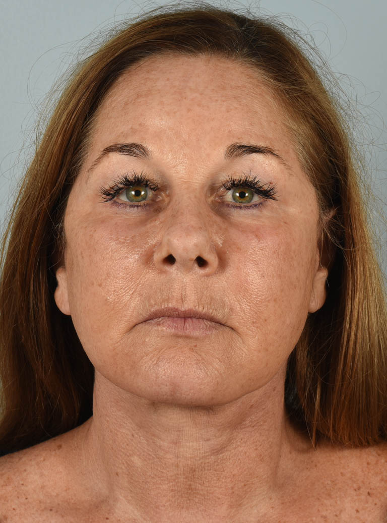 Eyelid Surgery case #11400