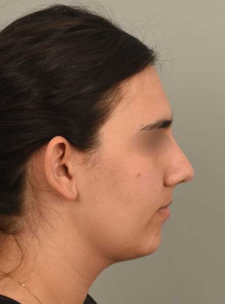 Buccal Fat Reduction case #11294