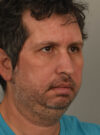 Chin Augmentation case #11311