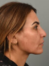 Rhinoplasty case #11716