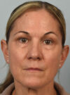 Eyelid Surgery case #11803