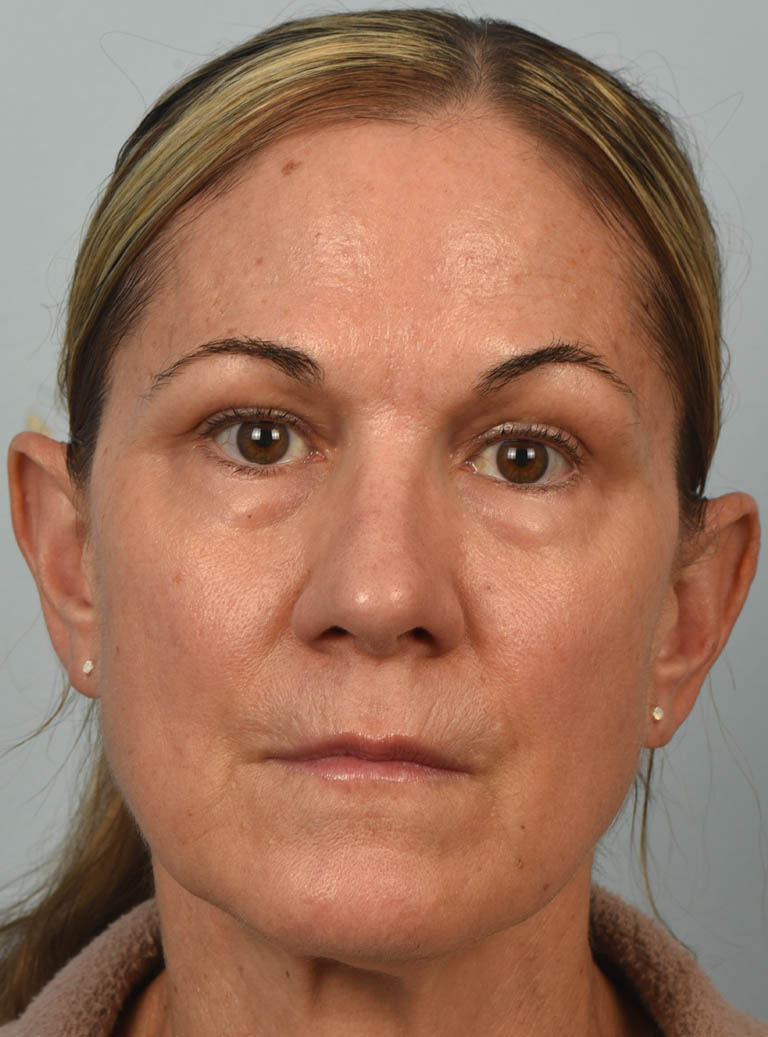 Eyelid Surgery case #11803