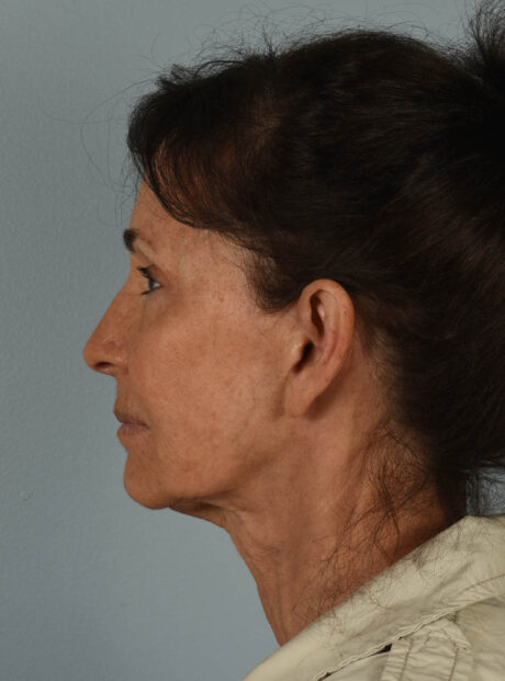 Facelift case #11514