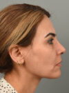 Rhinoplasty case #11716