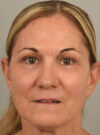 Eyelid Surgery case #11803