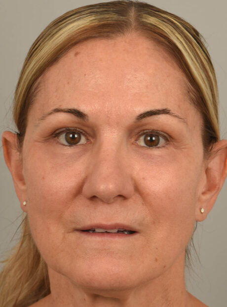 Eyelid Surgery case #11803