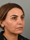 Rhinoplasty case #11716