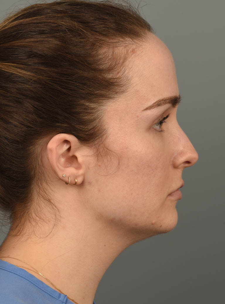 Deep Neck Contouring case #11360