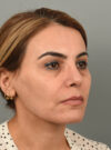 Rhinoplasty case #11716