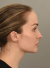 Deep Neck Contouring case #11360