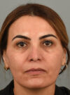 Rhinoplasty case #11716