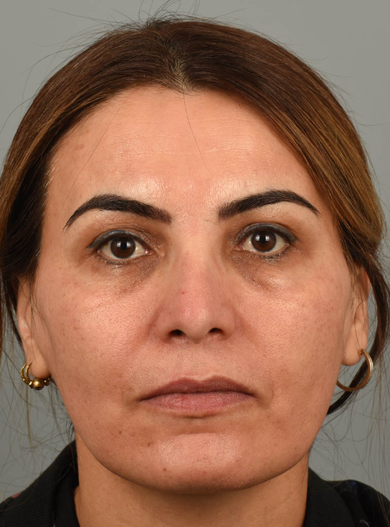 Rhinoplasty case #11716