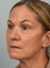 Eyelid Surgery case #11803