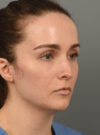 Deep Neck Contouring case #11360