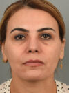 Rhinoplasty case #11716