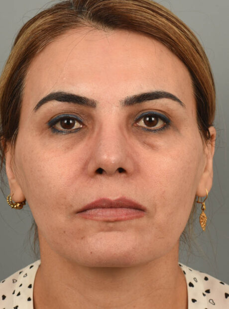 Rhinoplasty case #11716