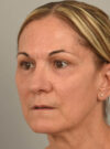 Eyelid Surgery case #11803