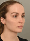 Deep Neck Contouring case #11360