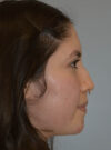 Rhinoplasty case #11705
