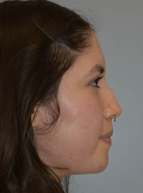 Rhinoplasty case #11705