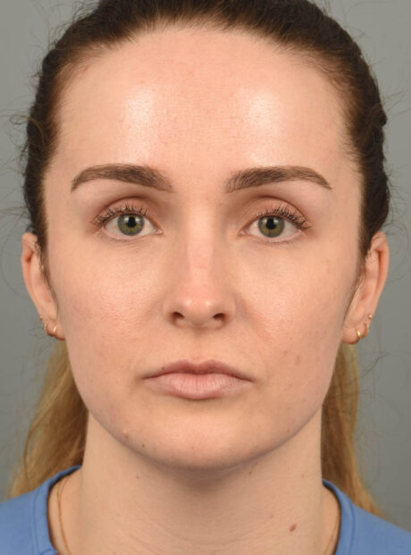 Deep Neck Contouring case #11360