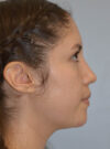 Rhinoplasty case #11705