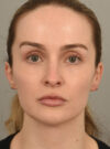Deep Neck Contouring case #11360
