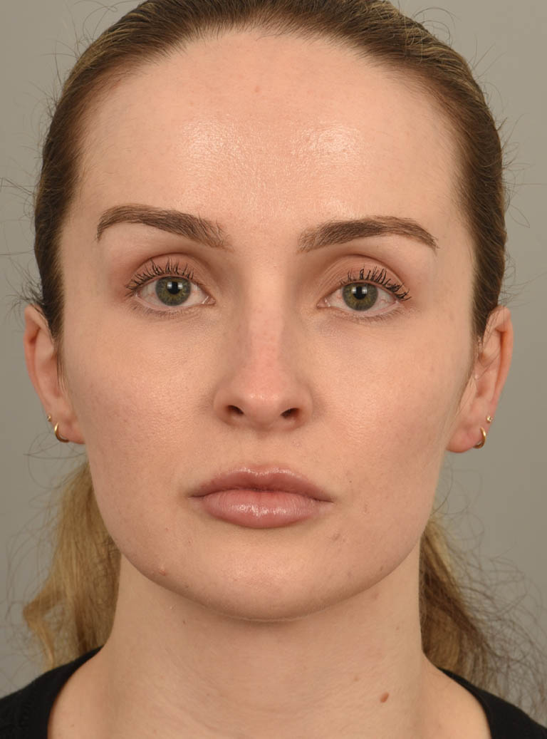 Deep Neck Contouring case #11360