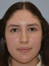 Rhinoplasty case #11705