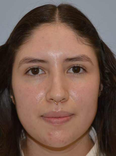 Rhinoplasty case #11705