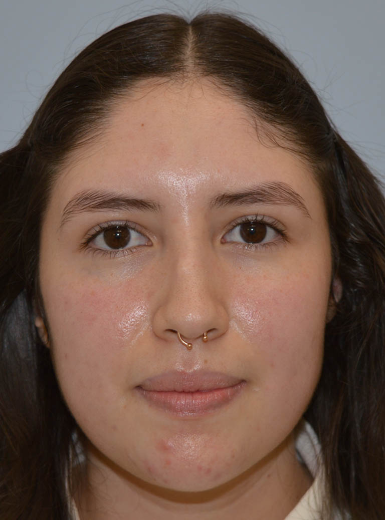 Rhinoplasty case #11705
