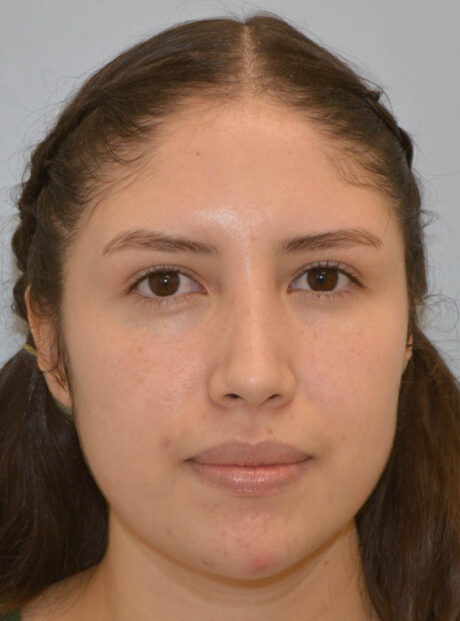 Rhinoplasty case #11705