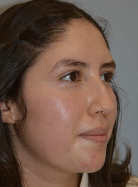 Rhinoplasty case #11705