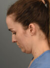 Deep Neck Contouring case #11360