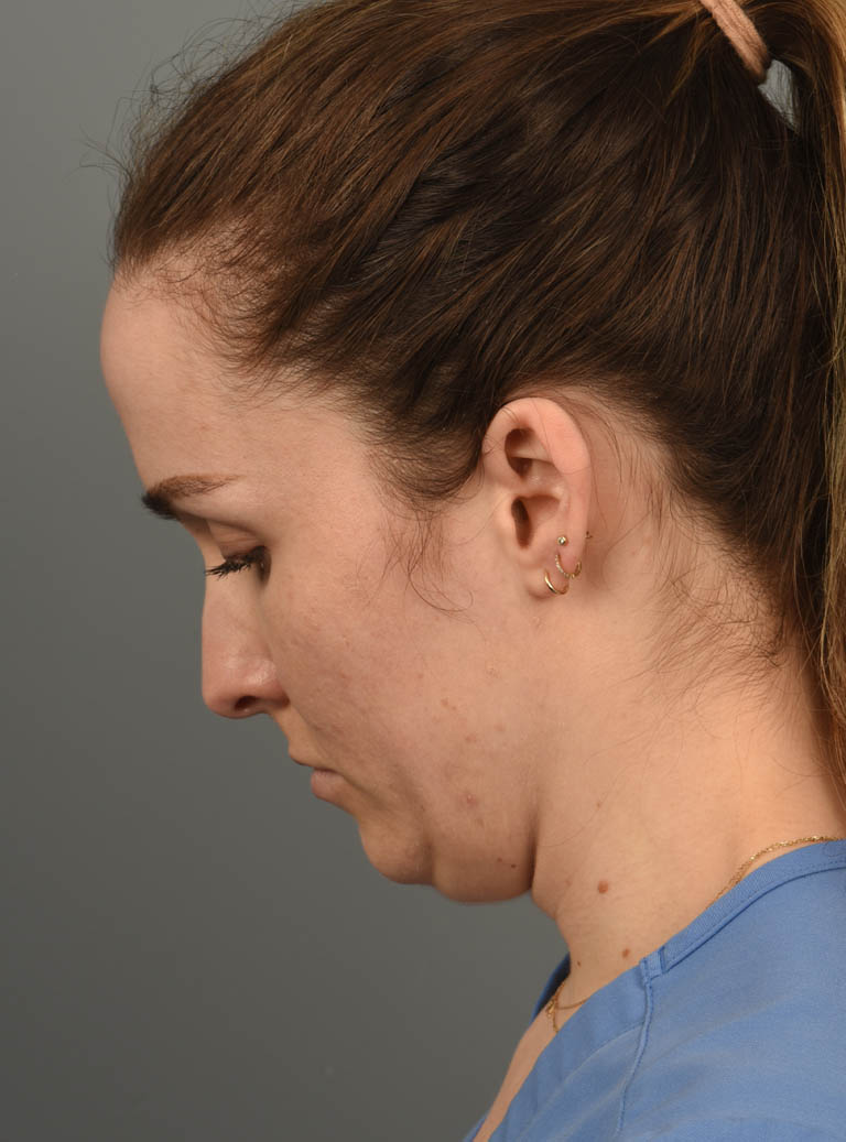 Deep Neck Contouring case #11360