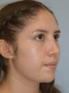 Rhinoplasty case #11705