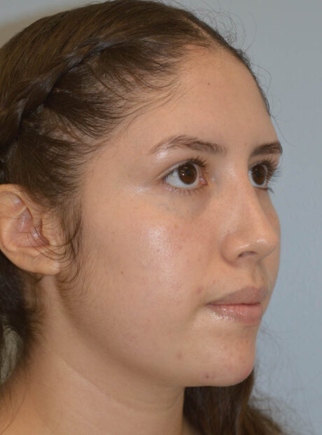 Rhinoplasty case #11705