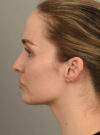 Deep Neck Contouring case #11360